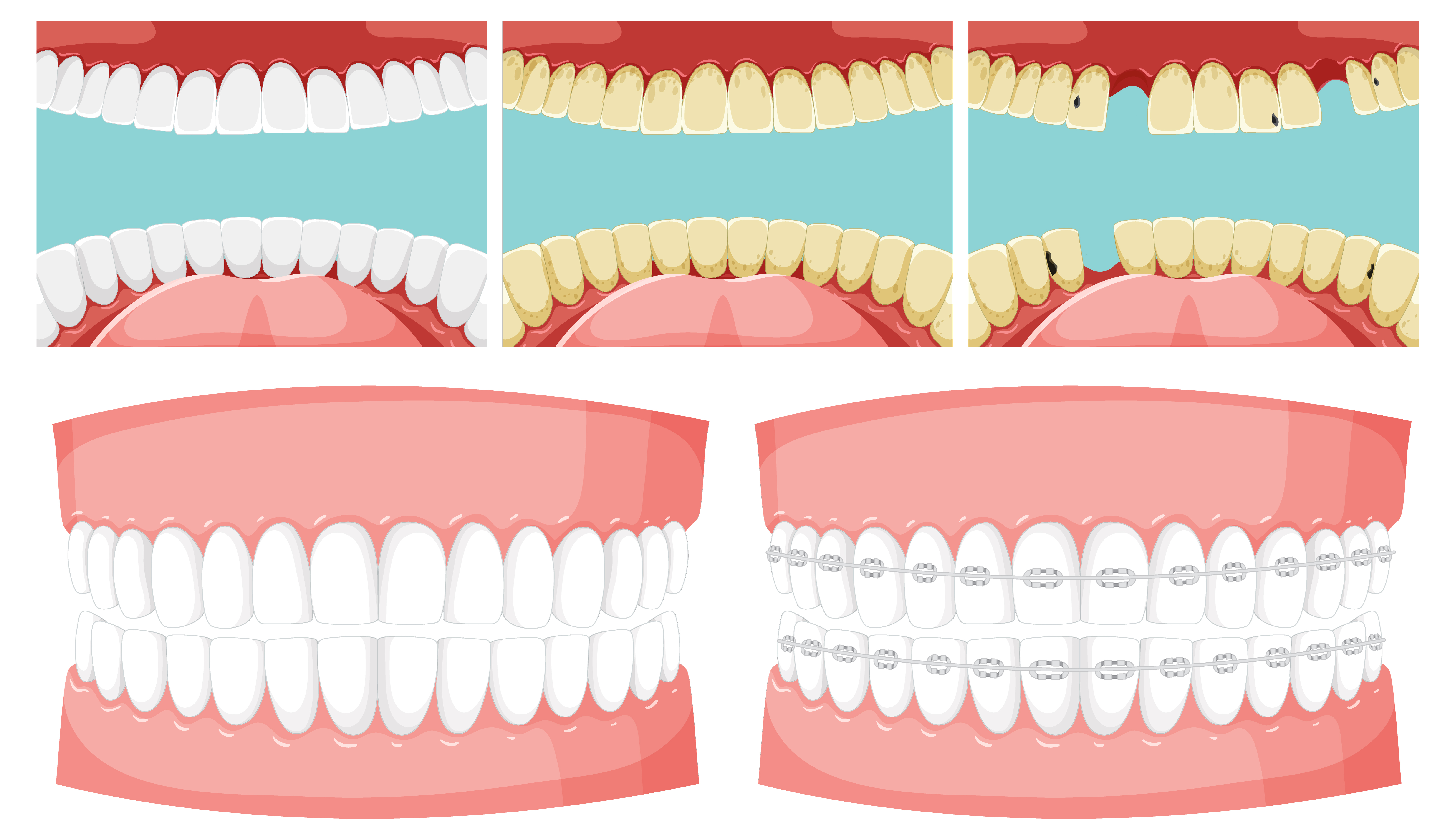 TOOTH FILLINGS IN GURGAON: TREATMENT, TYPES, PROCESS & COST